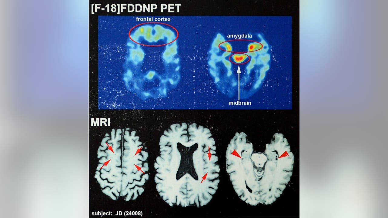Study reveals pre-CTE damage in brains of even young contact-sport athletes