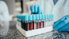 New blood test can detect early signs of ALS, study finds