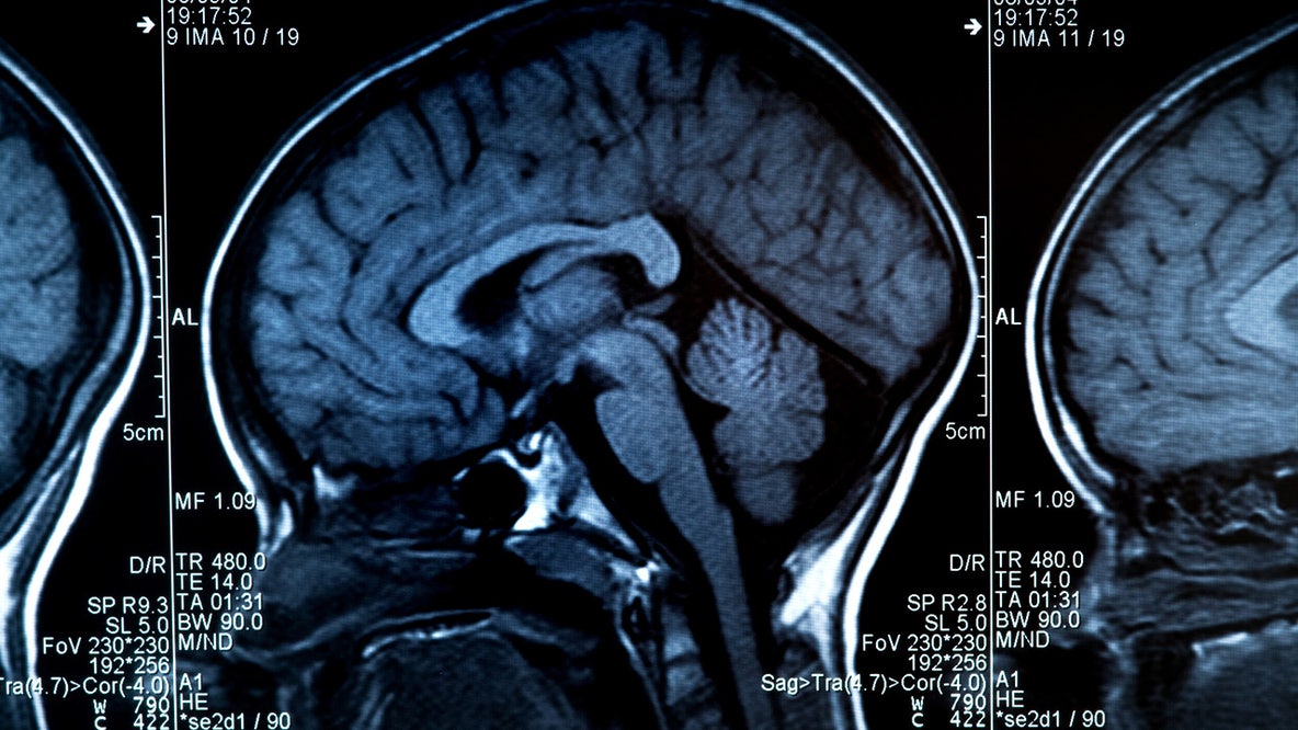 Alzheimer’s disease could be reversed by restoring brain balance, study suggests