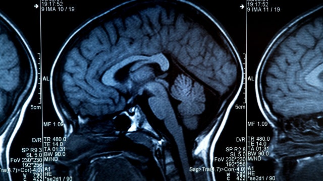 Alzheimer’s disease could be reversed by restoring brain balance, study suggests