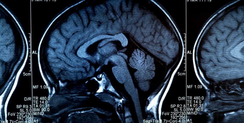 alzheimers.jpg?ve=1&tl=1