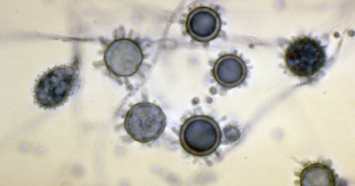 What is histoplasmosis? Outbreak leaves 1 dead, dozens ill in Tennessee