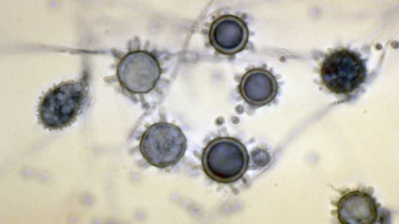 What is histoplasmosis? Outbreak leaves 1 dead, dozens ill in Tennessee