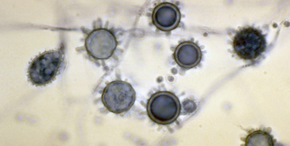 What is histoplasmosis? Outbreak leaves 1 dead, dozens ill in Tennessee