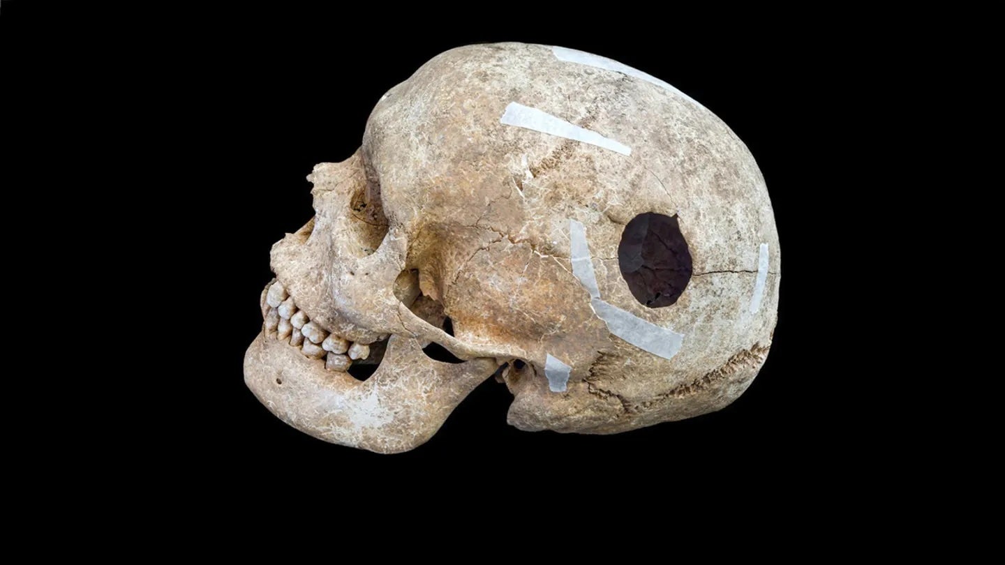 Stunning discovery in mass grave might be world's first surgery