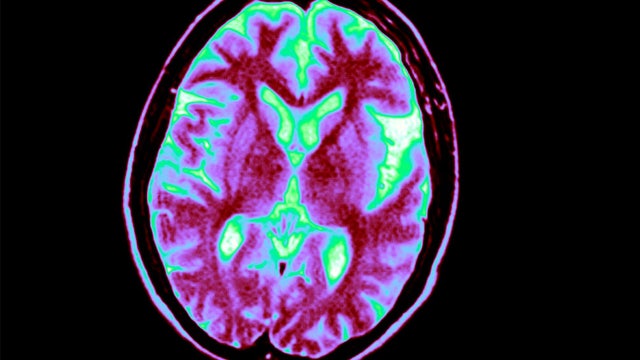 Blood test could predict what age Alzheimer's symptoms will start, new study suggests