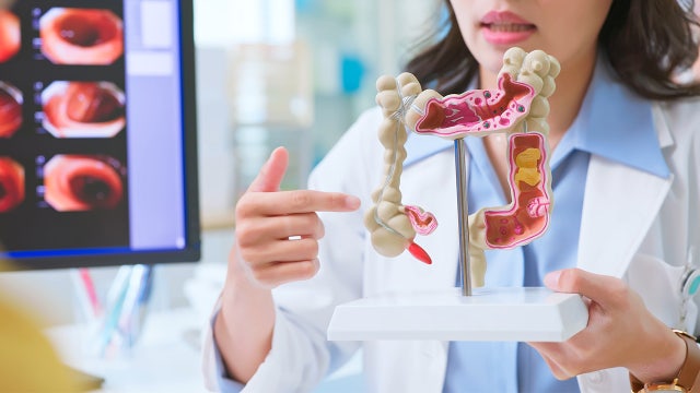 Colorectal cancer: Symptoms and what causes it