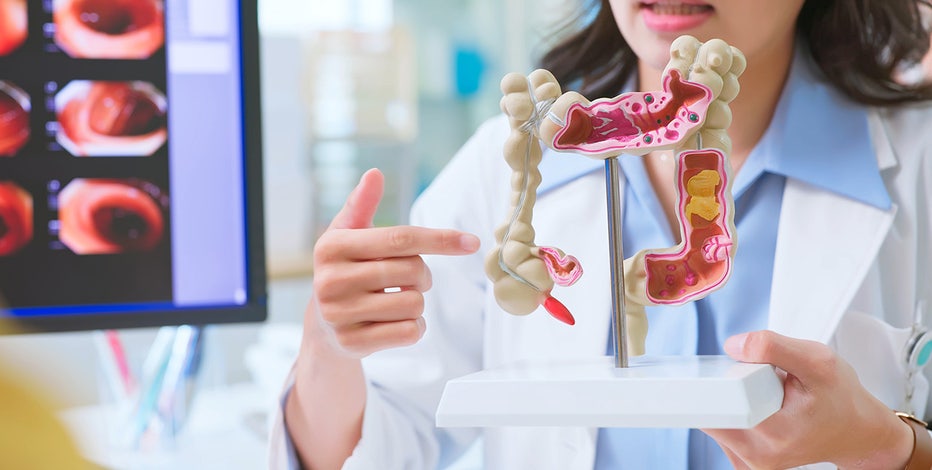 Colorectal cancer: Symptoms and what causes it