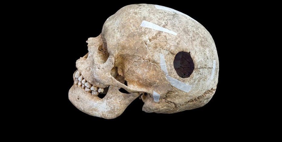 Dimmoire Dig in SkullオフショルT ホワット Stunning discovery in mass grave might be world's first surgery