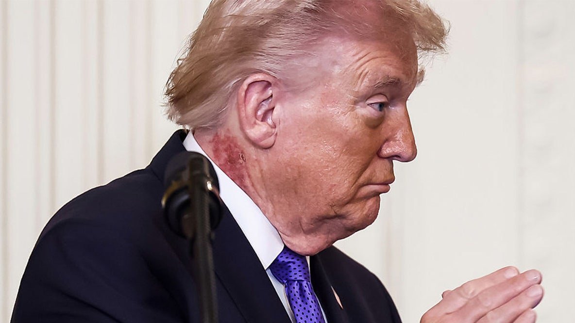 Trump’s neck rash draws attention online: Here’s what to know