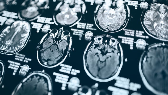 Kidney disease may trigger rare, potentially fatal brain virus, study says