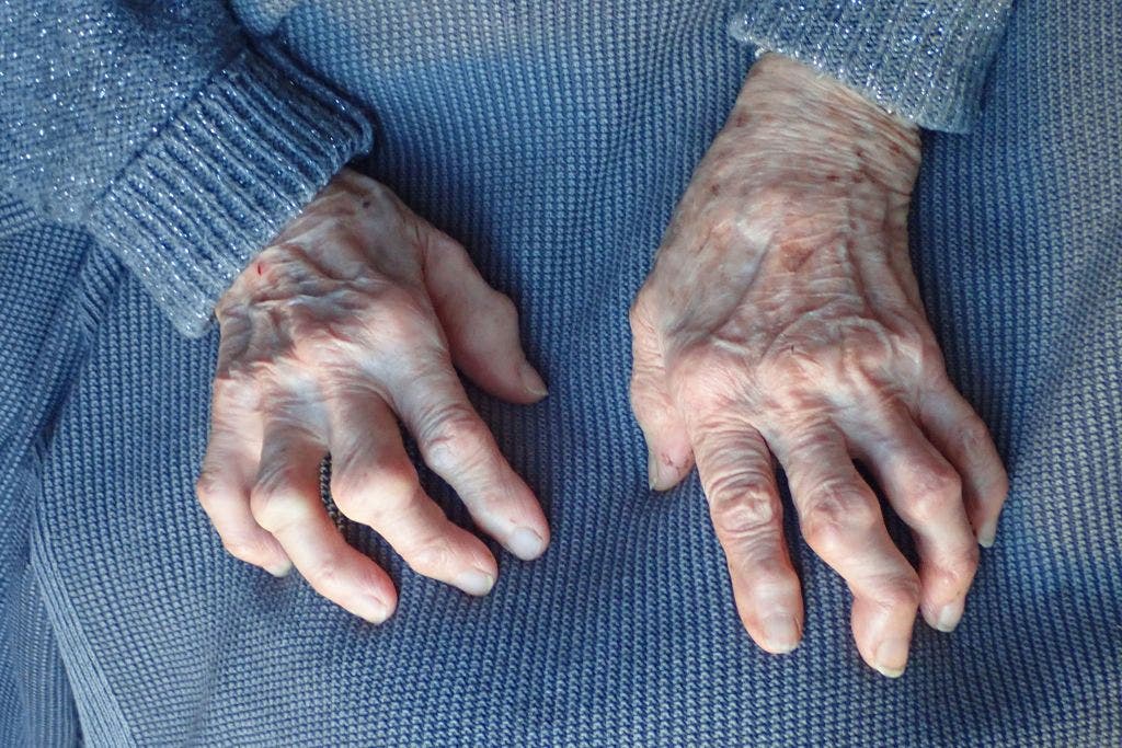 Simple shot may reverse osteoarthritis in just weeks, researchers say