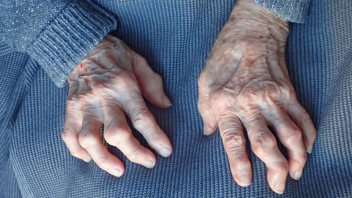 Simple shot may reverse osteoarthritis in just weeks, researchers say