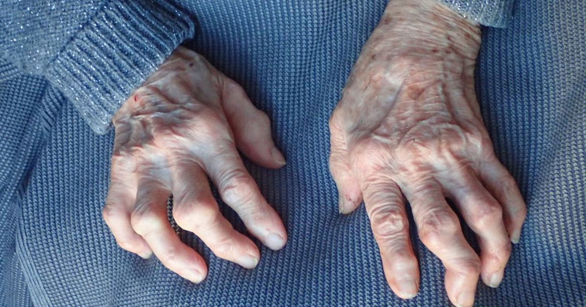 Simple shot may reverse osteoarthritis in just weeks, researchers say