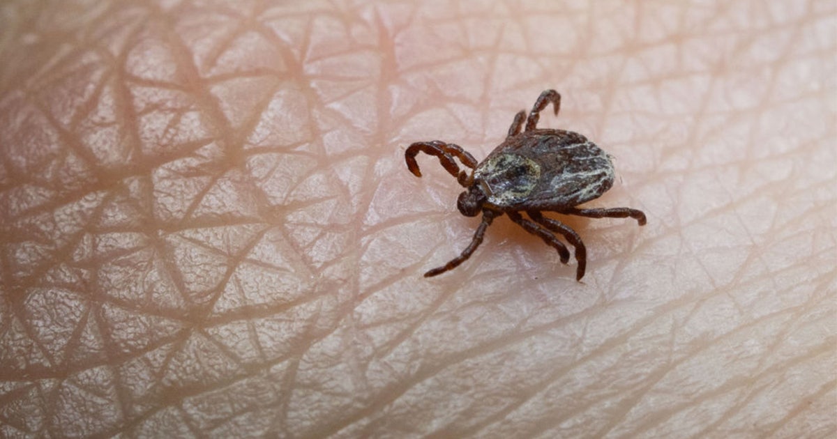 Tick bite ER visits hit highest seasonal level in years as doctors warn of disease surge