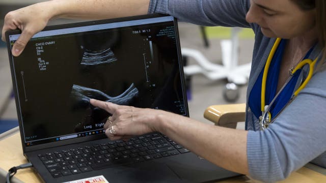 PCOS gets new name in effort to improve diagnosis for millions of women