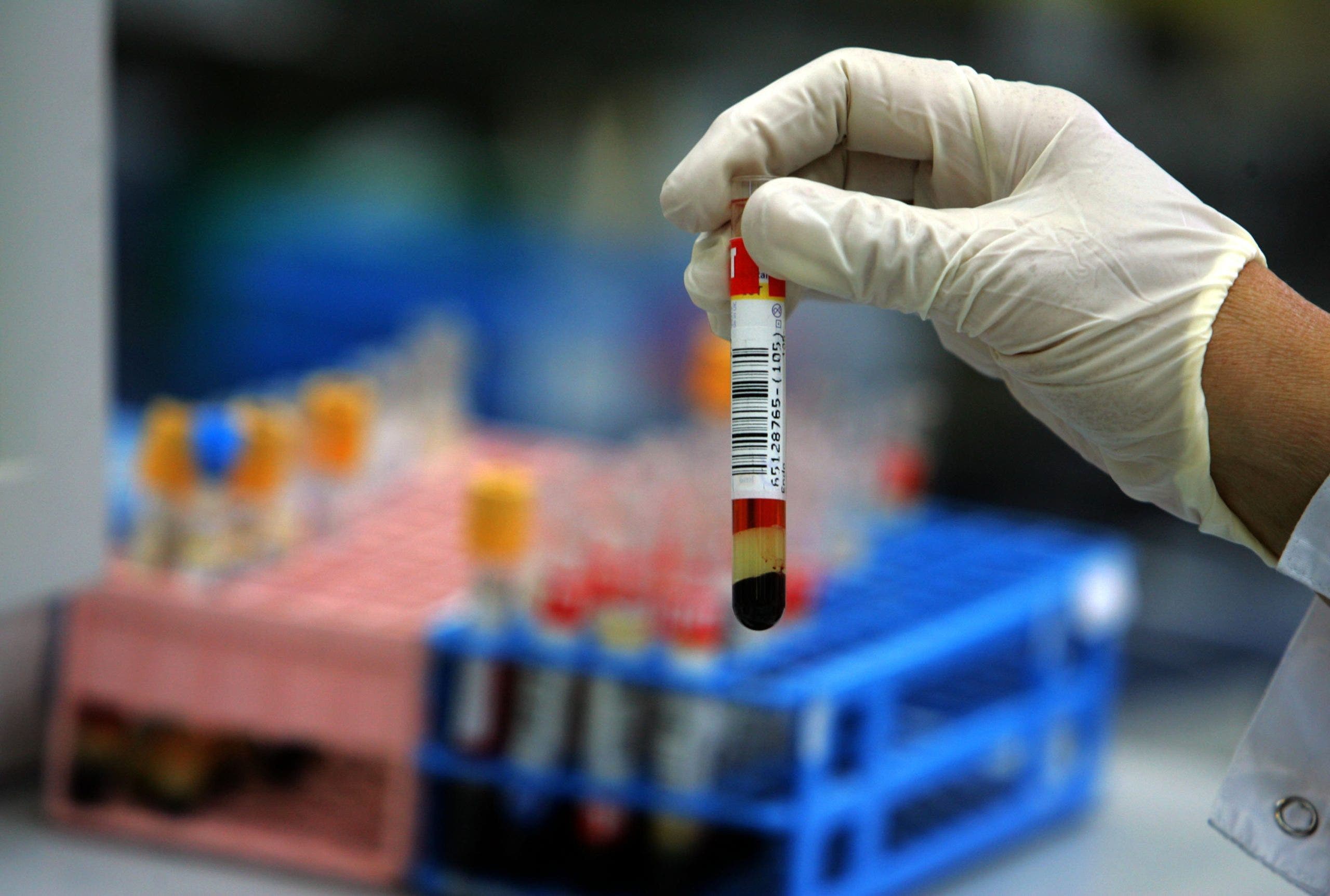 Blood test could help identify people at high risk for Alzheimer's, study suggests