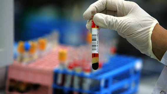 Blood test could help identify people at high risk for Alzheimer's, study suggests