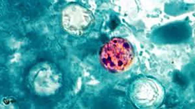 Cyclosporiasis map: 29 states now investigating diarrheal illness