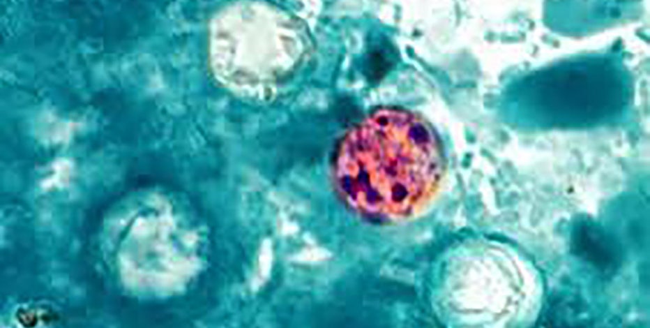 CDC: Cyclosporiasis occurs in many countries, past US cases linked to imported produce