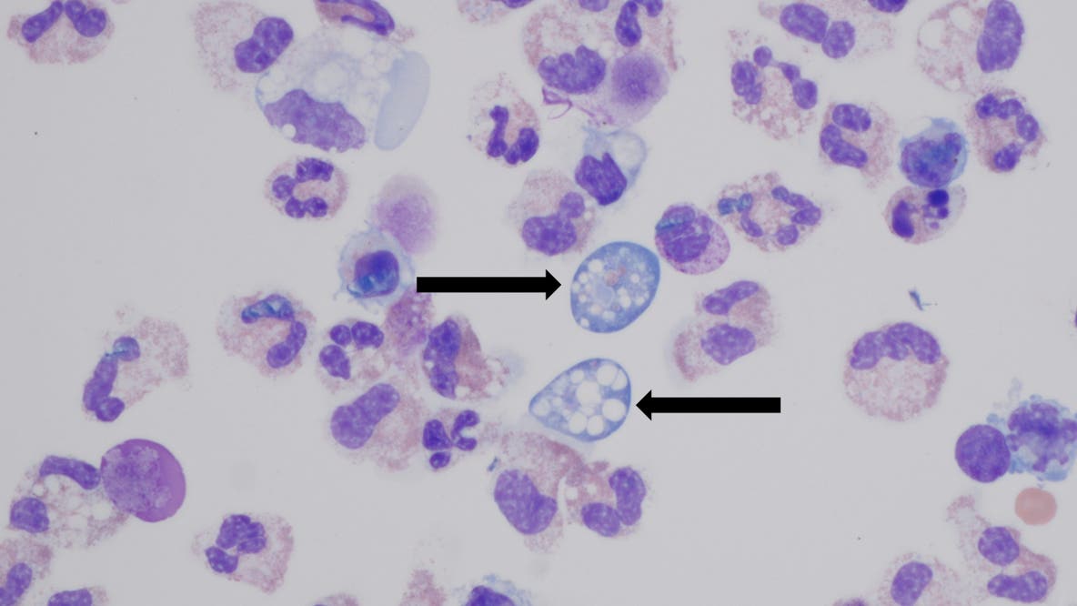 Brain-eating amoeba leaves NC teen critically injured