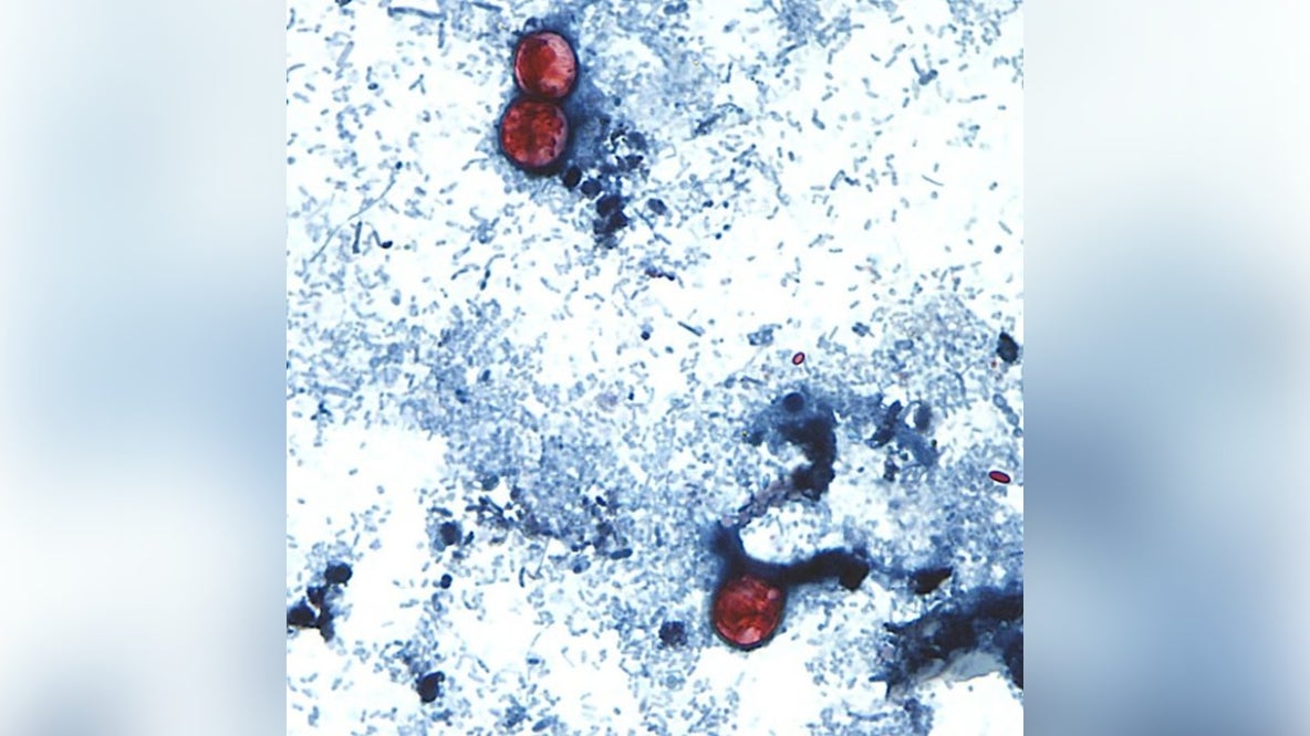 Cyclospora research projects shuttered as US cases climb