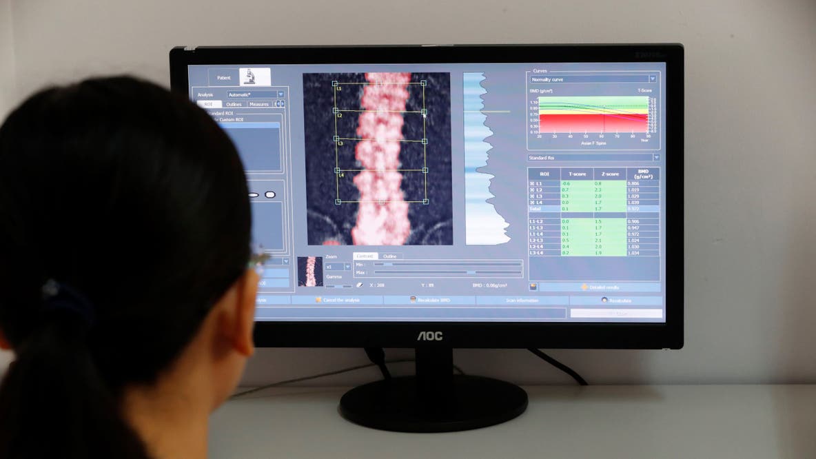 Popular drugs for bone health linked to significantly lower Alzheimer's risk