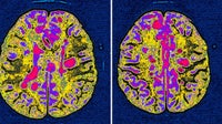 Modified HIV drug could reverse vision loss, paralysis from MS, study suggests