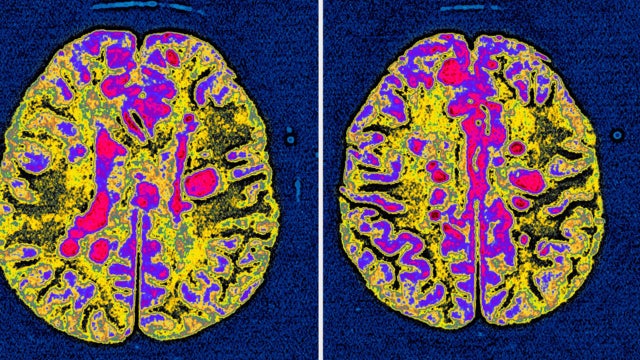 Modified HIV drug could reverse vision loss, paralysis from MS, study suggests