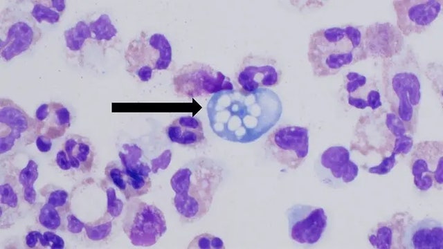Teen dies from brain-eating amoeba just days after Louisiana child's death