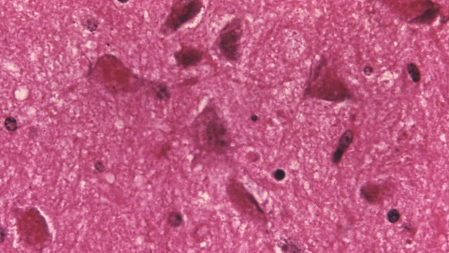 CDC warns of rise in animal rabies activity and human exposures: Here’s what to know