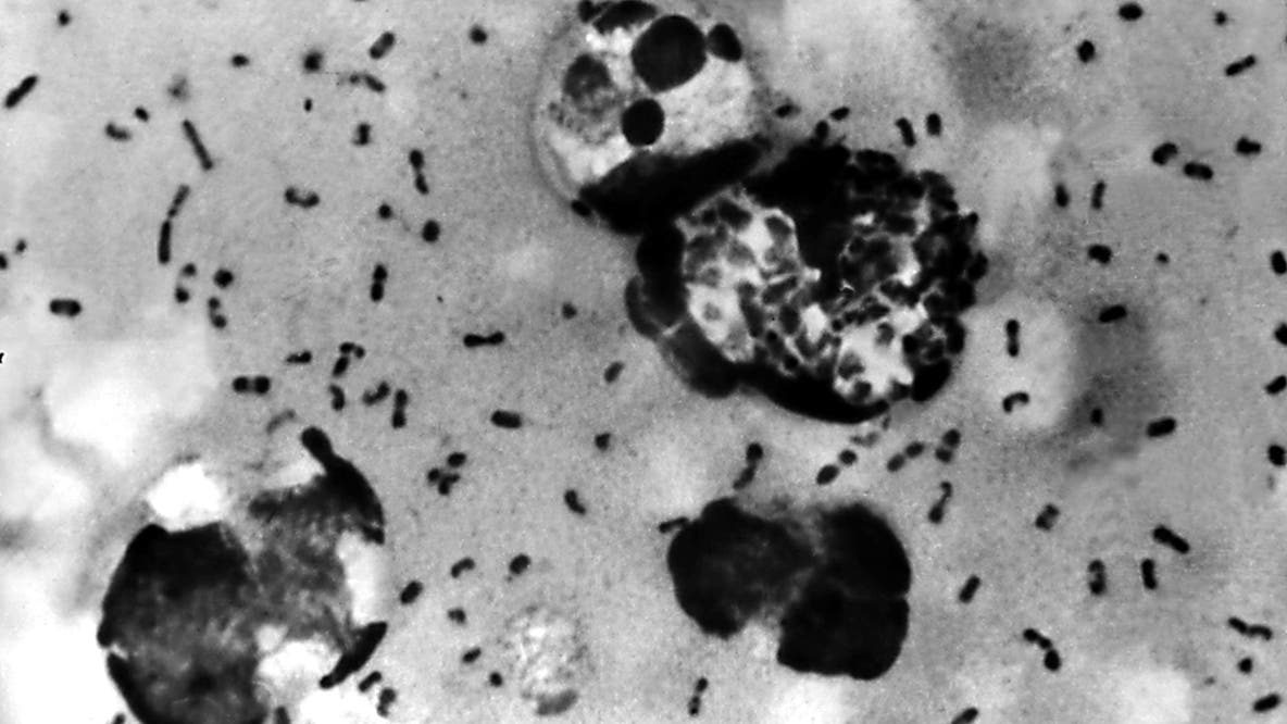 US monitoring suspected fatal pneumonic plague case in Russia, State Department official says