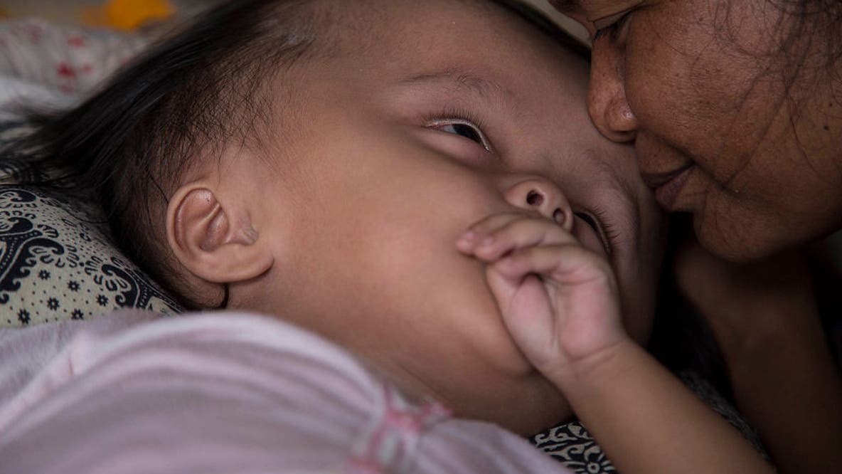 Researchers test gene therapy as less invasive treatment for hydrocephalus