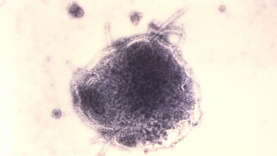 Pennsylvania measles outbreak passes 1,000 cases in worst year for US since 1991