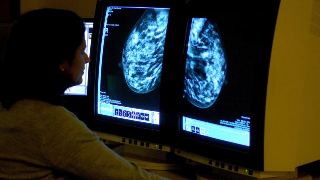 Targeted drug shrinks tumors in 3 out of 4 patients with advanced breast cancer
