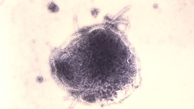 Pennsylvania measles outbreak passes 1,000 cases in worst year for US since 1991