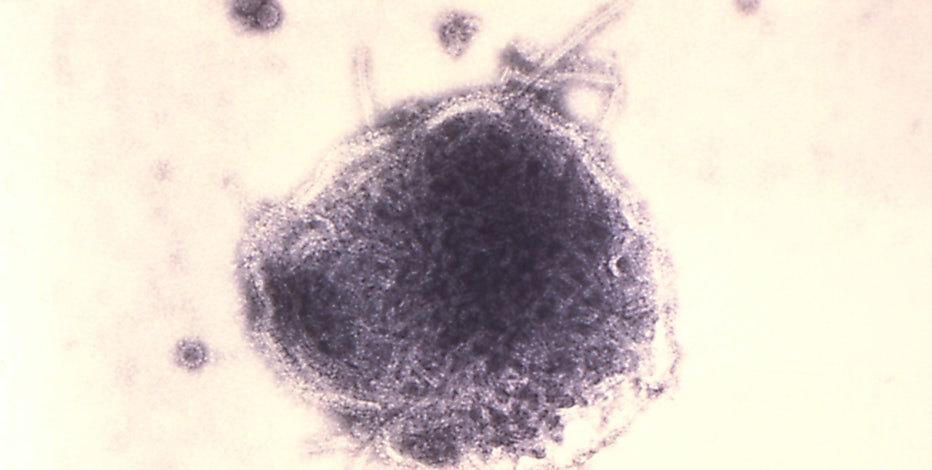 Pennsylvania measles outbreak passes 1,000 cases in worst year for US since 1991