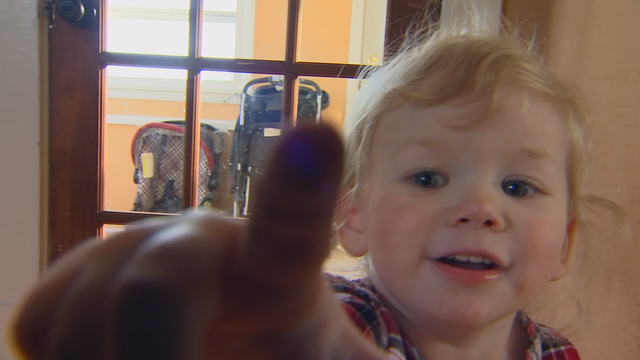 Rare condition means Minnesota toddler is allergic to water