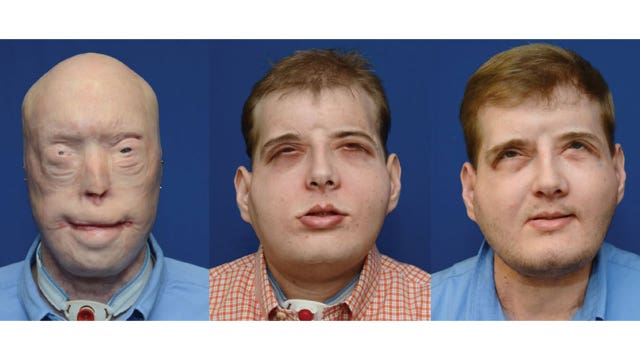 Recipient of most extensive face transplant "thriving"