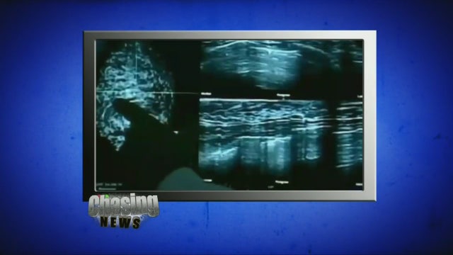 New mammogram guidelines spark controversy