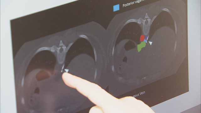 Emory doctors freeze 'hunger' nerve for weight loss