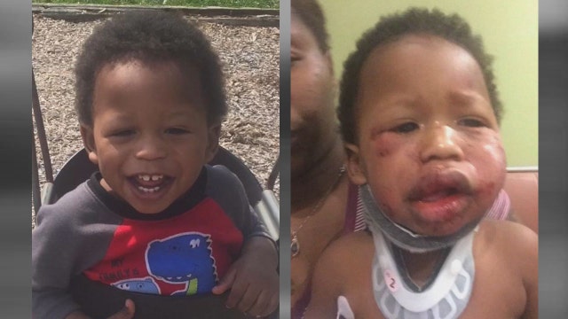 Baby hospitalized after beating at daycare