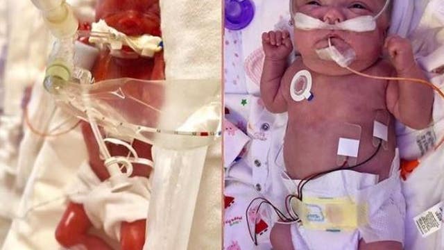 Photos show healthy transformation of preemie in the NICU