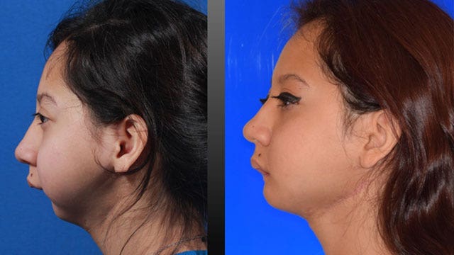 Teen gets new jaw in historic surgery