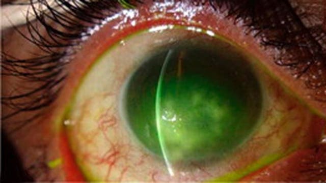 Man claims he contracted eye-eating parasite from amusement park water ride