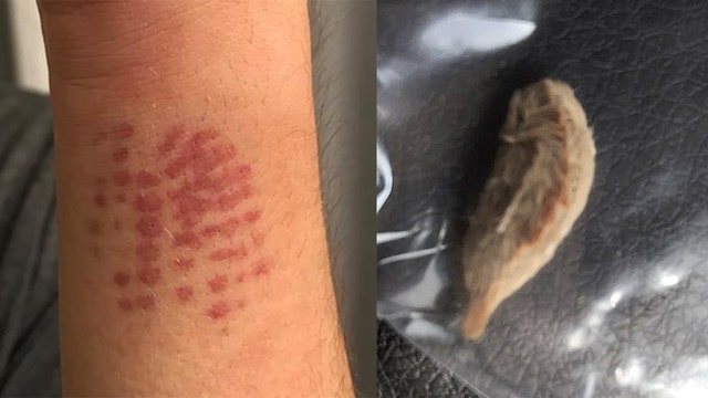 Land O' Lakes mom sends warning after son stung by venomous caterpillar