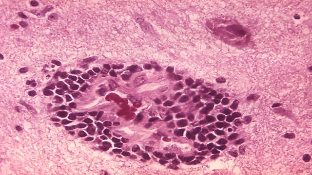 Florida boy, 6, dies of rabies contracted from a bat