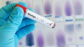 First mumps case since 2018 reported in Whatcom County, WA