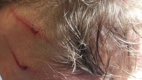 Teen bit in head by bear wakes up to 'crunching sound'