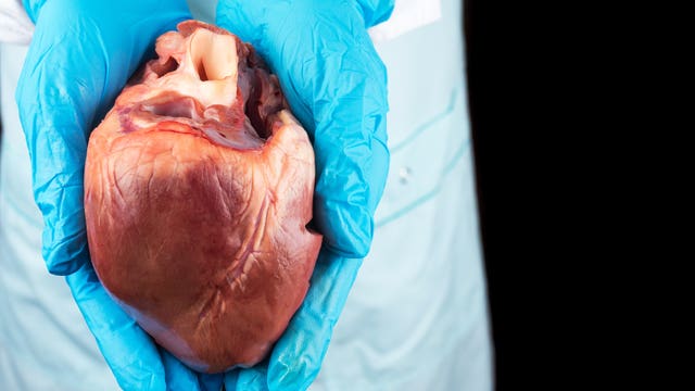 Last heart transplant doctor leaves Oregon